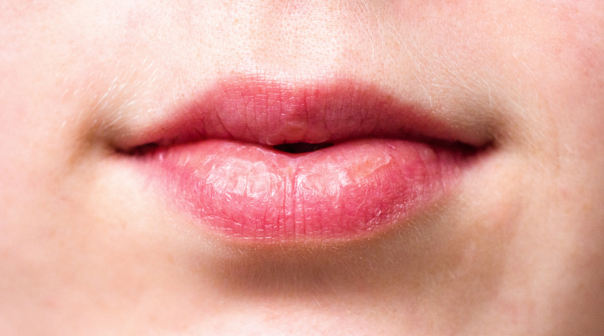 Nahaufnahme trockener Lippen bei Hitze